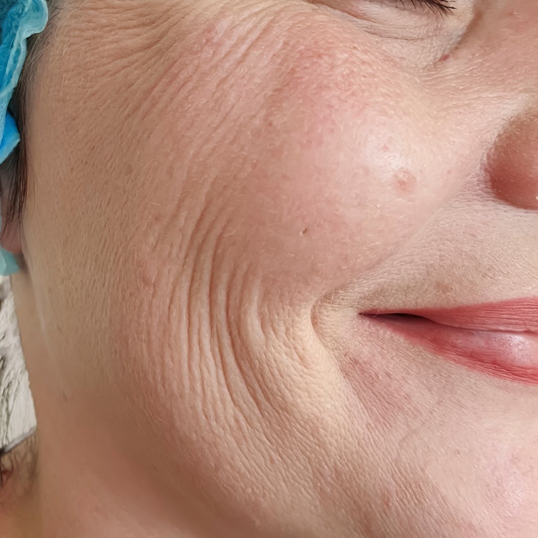 avant centre anti age